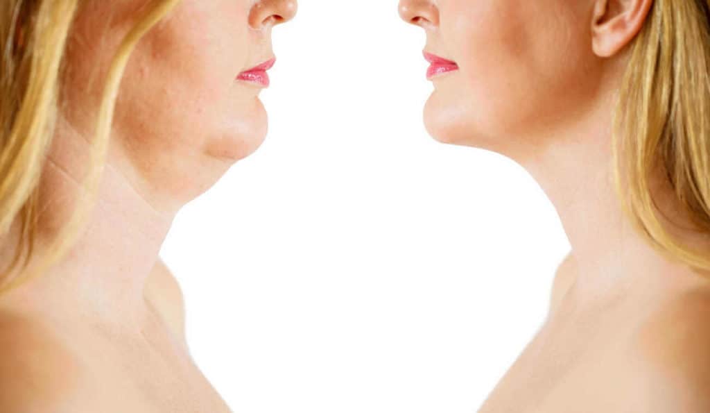 Double Chin treatment Bexleyhill before and after results