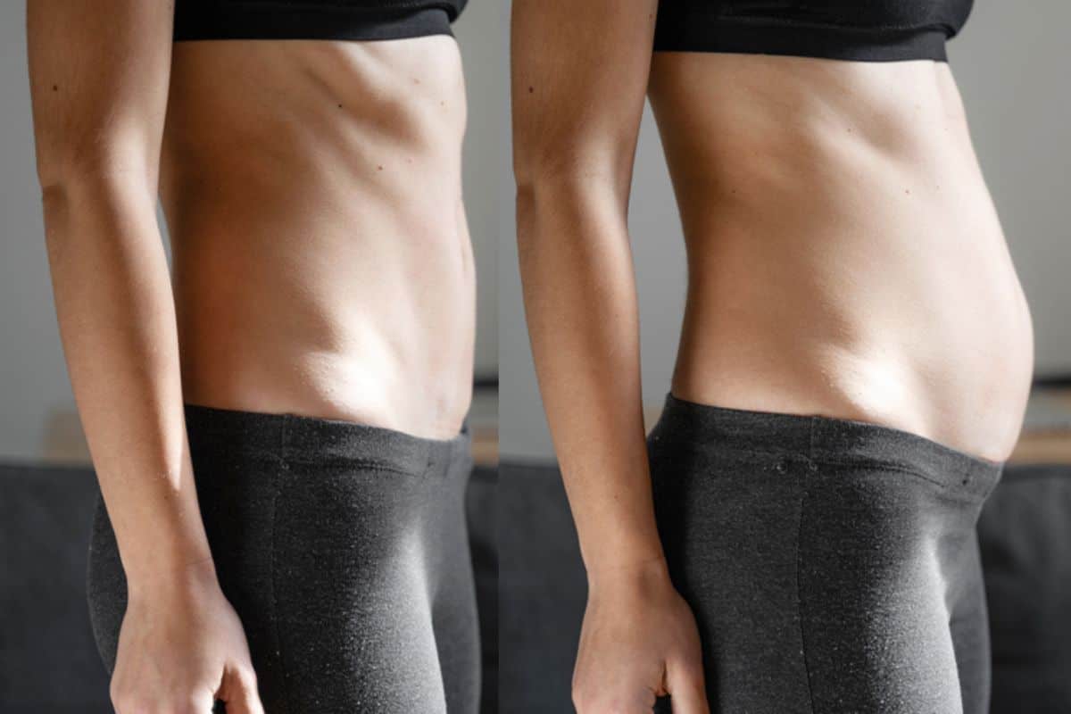 How long does diastasis recti take to improve Bexleyhill?