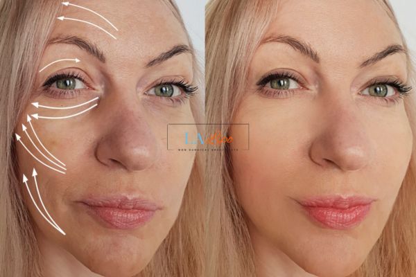 Morpheus 8 results Bexleyhill face lift.