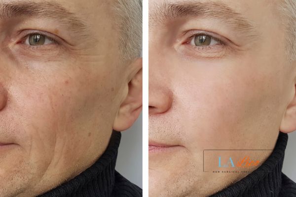 See the amazing results of Morpheus8 Treatment Bexleyhill!