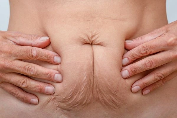 Should I Combine Diastasis Recti Treatment with Body Contouring for Better Results Bexleyhill?